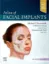 Imagem de Atlas of Facial Implants