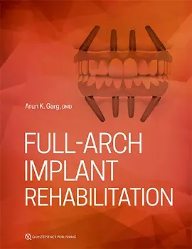 Imagem de Full-Arch Implant Rehabilitation