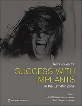 Imagem de Techniques for Success with Implants in the Esthetic Zone