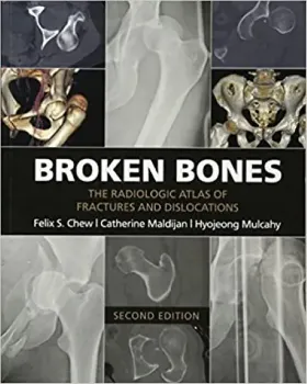 Picture of Book Broken Bones: The Radiologic Atlas of Fractures and Dislocations