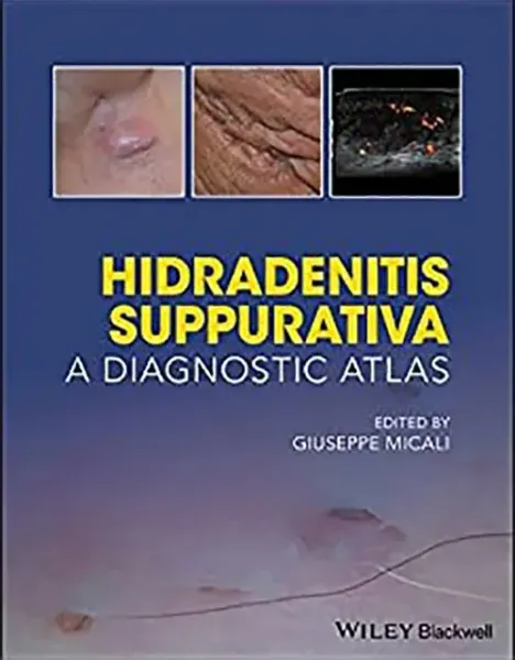 Imagem de Hidradenitis Suppurativa: A Diagnostic Atlas
