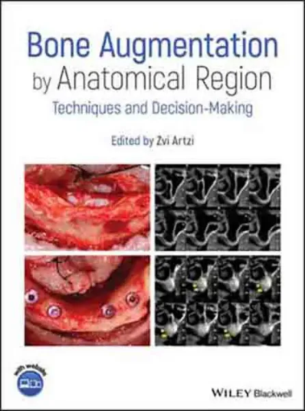 Imagem de Bone Augmentation by Anatomical Region: Techniques and Decision-Making