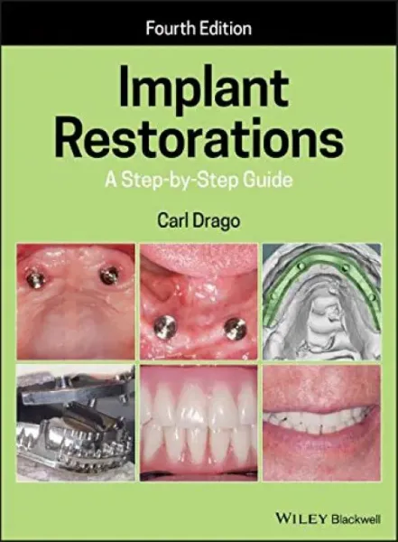 Imagem de Implant Restorations: A Step-by-Step Guide