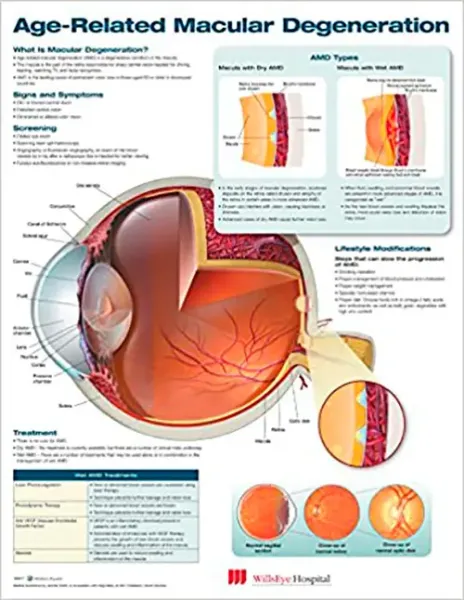 Imagem de Age-Related Macular Degeneration Anatomical Chart