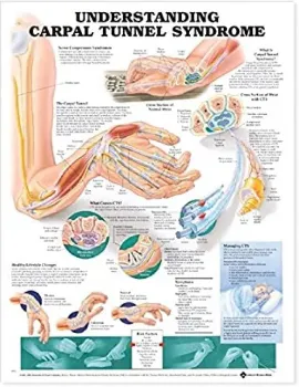 Picture of Book Understanding Carpal Tunnel Syndrome Anatomical Chart