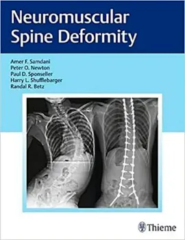 Imagem de Neuromuscular Spine Deformity