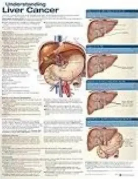 Picture of Book Understanding Liver Cancer Anatomical Chart