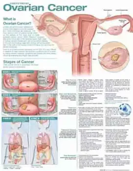 Picture of Book Understanding Ovarian Cancer Anatomical Chart