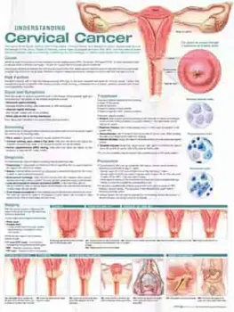 Picture of Book Understanding Cervical Cancer Anatomical Chart