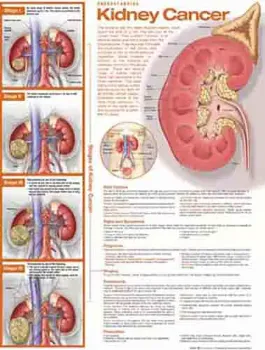 Picture of Book Understanding Kidney Cancer Anatomical Chart