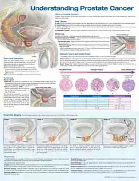 Imagem de Understanding Prostate Cancer Anatomical Chart