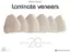Picture of Book Laminate Veneer 20 Recipes for Smile Design
