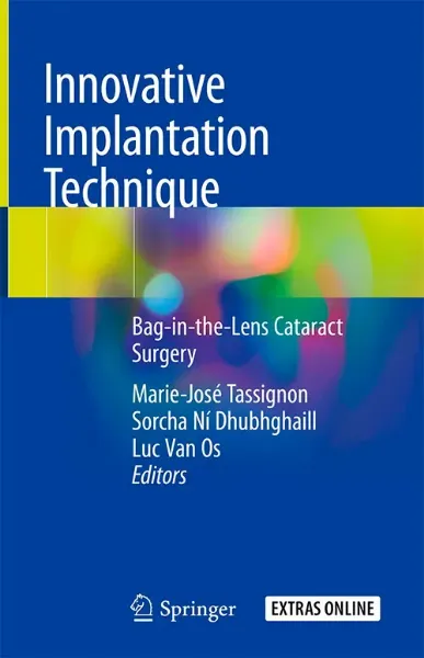 Imagem de Innovative Implantation Technique: Bag-in-the-Lens Cataract Surgery