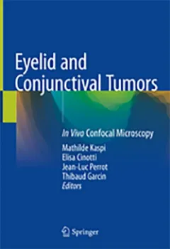 Imagem de Eyelid and Conjunctival Tumors: In Vivo Confocal Microscopy