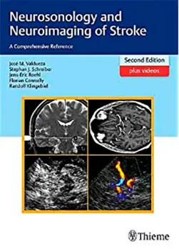Imagem de Neurosonology and Neuroimaging of Stroke: A Comprehensive Reference