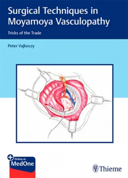 Imagem de Surgical Techniques in Moyamoya Vasculopathy: Tricks of the Trade