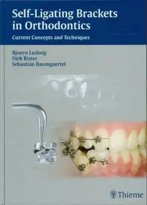 Imagem de Self-ligating Brackets in Orthodontics: Current Concepts and Techniques