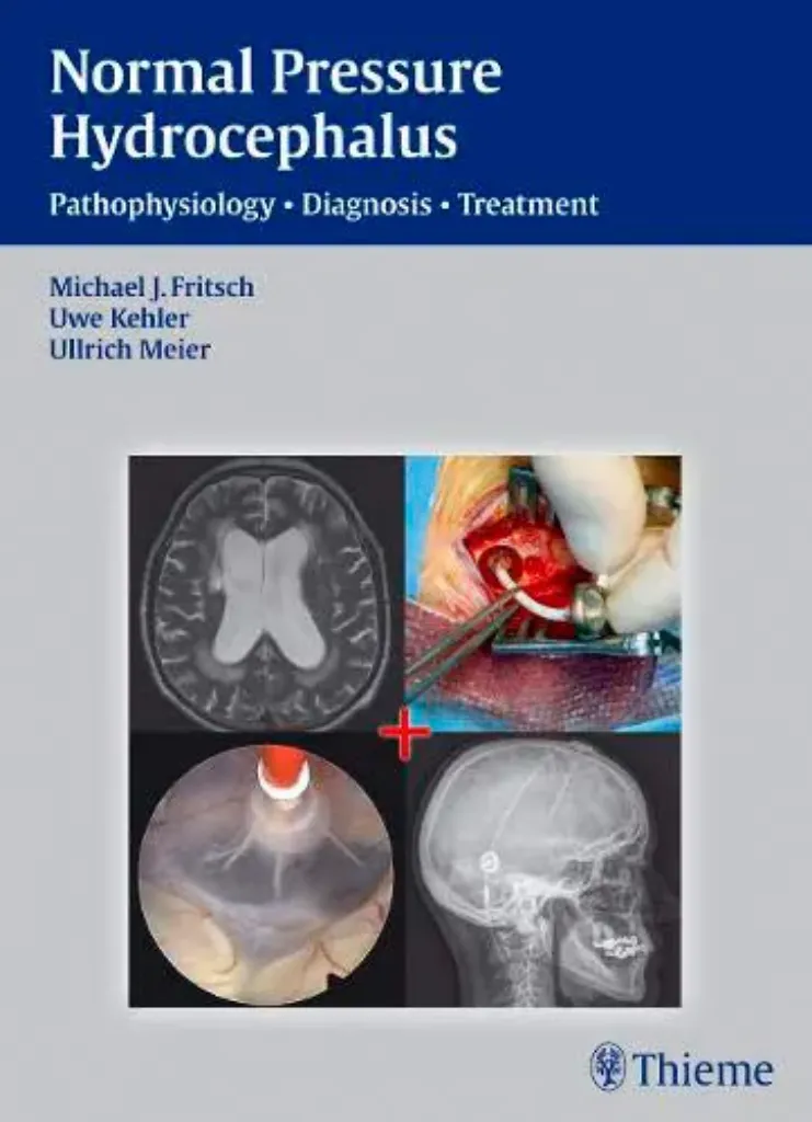 Imagem de NPH - Normal Pressure Hydrocephalus: Pathophysiology - Diagnosis - Treatment