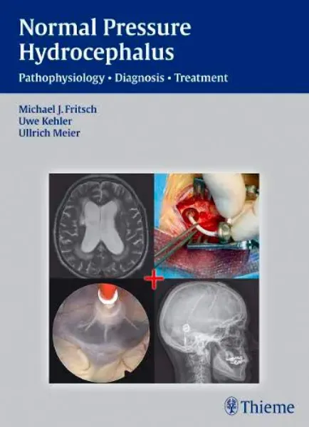 Imagem de NPH - Normal Pressure Hydrocephalus: Pathophysiology - Diagnosis - Treatment