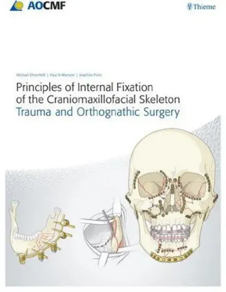 Imagem de Principles of Internal Fixation of The Craniomaxillofacial 2