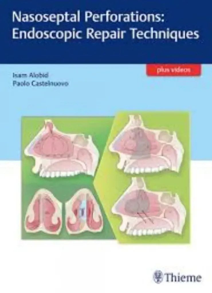 Imagem de Nasoseptal Perforations: Endoscopic Repair Techniques