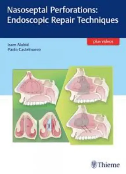 Imagem de Nasoseptal Perforations: Endoscopic Repair Techniques