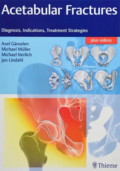 Imagem de Acetabular Fractures: Diagnosis, Indications, Treatment Strategies