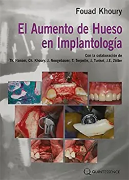 Imagem de El Aumento de Hueso en Implantología