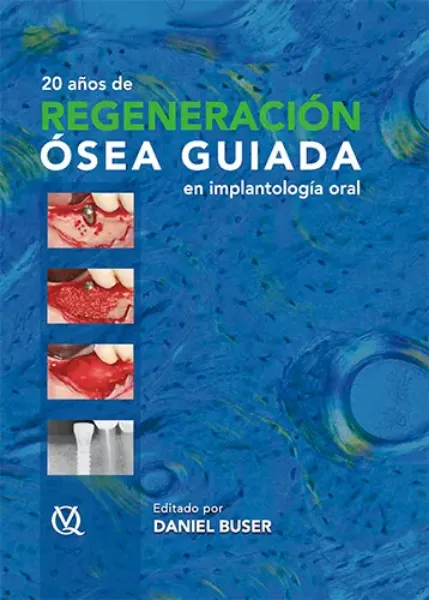 Imagem de 20 Años de Regeneración Ósea Guiada en Implantología