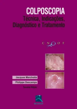 Imagem de Colposcopia - Técnica, Indicações, Diagnóstico e Tratamento