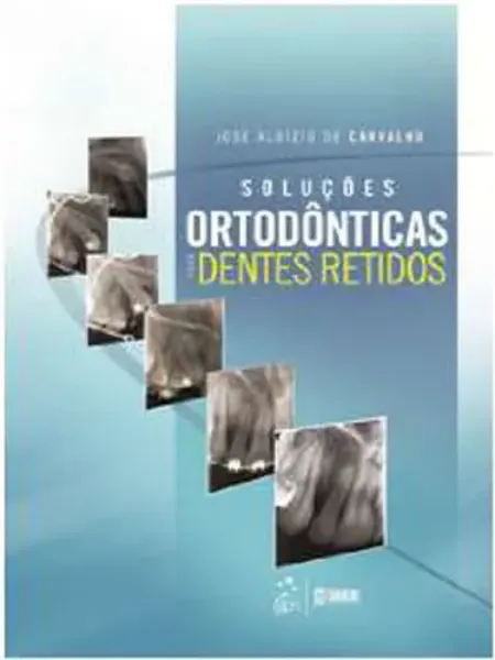 Imagem de Soluções Ortodonticas para Dentes Retidos