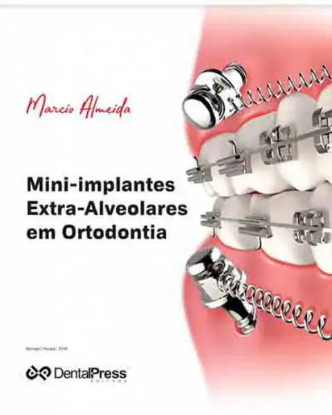 Imagem de Mini-implantes Extra-Alveolares em Ortodontia