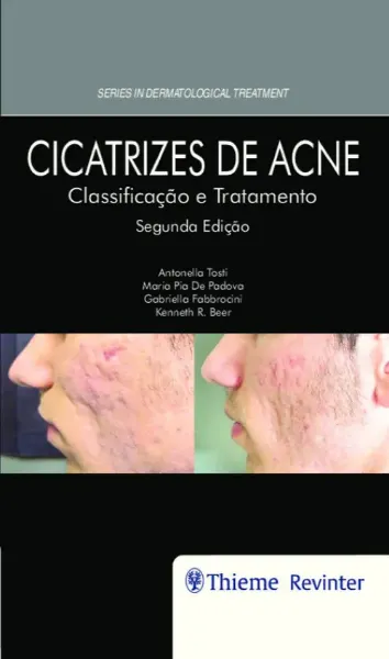Imagem de Cicatrizes de Acne