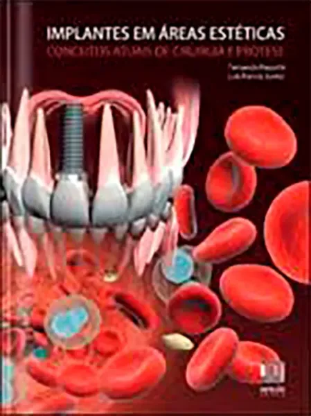 Imagem de Implantes em Áreas Estéticas - Conceitos Atuais de Cirurgia e Prótese