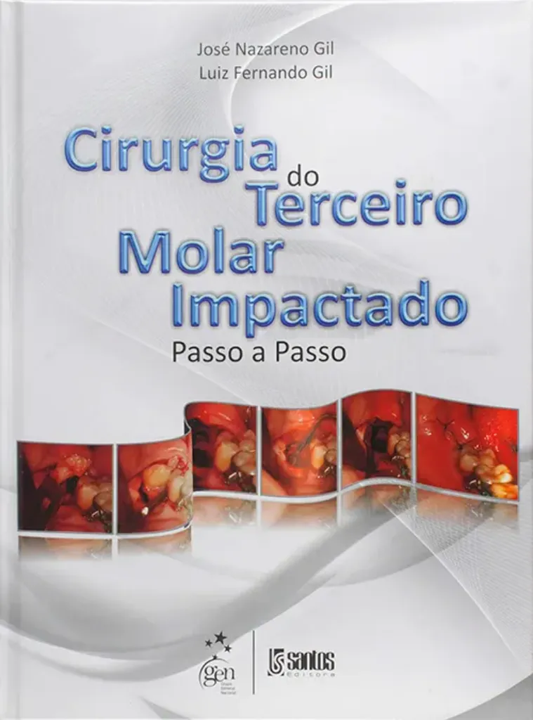 Imagem de Cirurgia do Terceiro Molar Impactado Passo a Passo