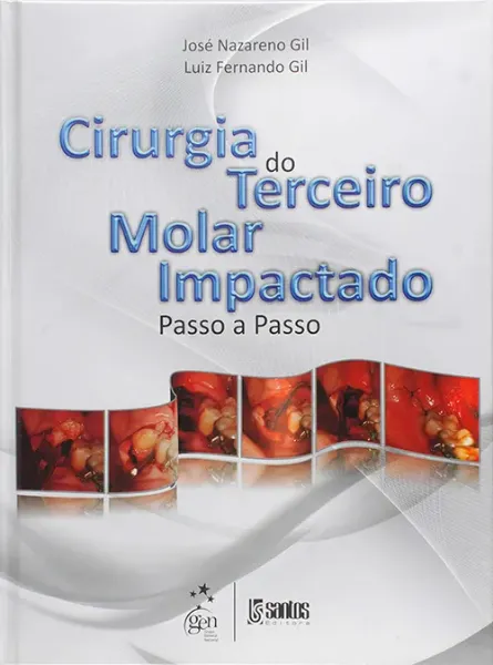 Imagem de Cirurgia do Terceiro Molar Impactado Passo a Passo
