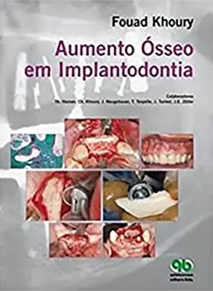 Imagem de Aumento Ósseo em Implantodontia