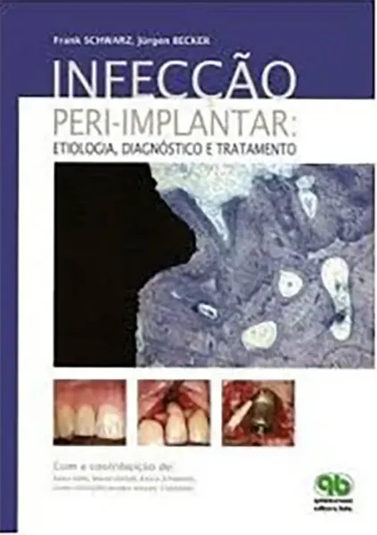 Imagem de Infecção Peri-Implantar: Etiologia, Diagnóstico e Tratamento
