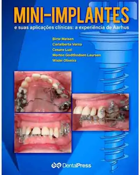Imagem de Mini-Implantes: e suas aplicações clínicas