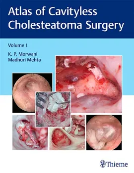 Imagem de Atlas of Cavityless Cholesteatoma Surgery Vol. 1