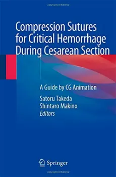 Imagem de Compression Sutures for Critical Hemorrhage During Cesarean Section: A Guide by CG Animation