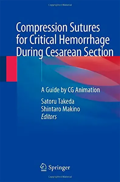 Imagem de Compression Sutures for Critical Hemorrhage During Cesarean Section: A Guide by CG Animation