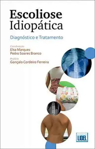 Imagem de Escoliose Idiopática