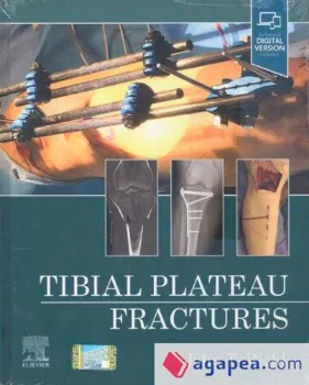 Picture of Book Tibial Plateau Fractures