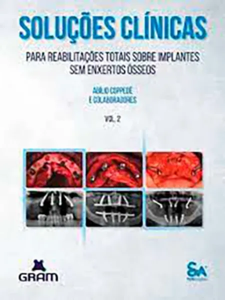 Imagem de Soluções Clínicas para Reabilitações Totais Sobre Implantes sem Enxertos Ósseos Vol. 2