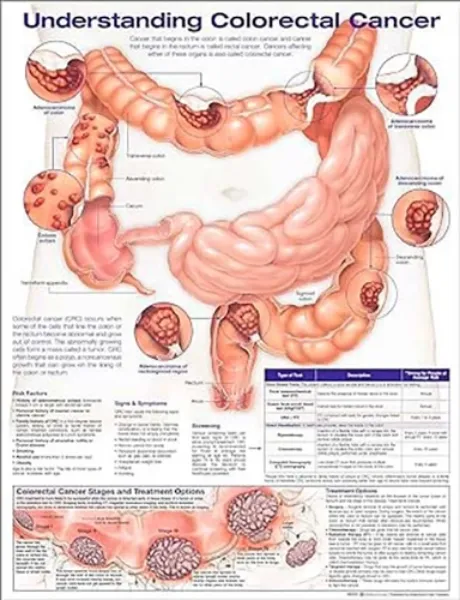 Imagem de Understanding Colorectal Cancer Anatomical Chart