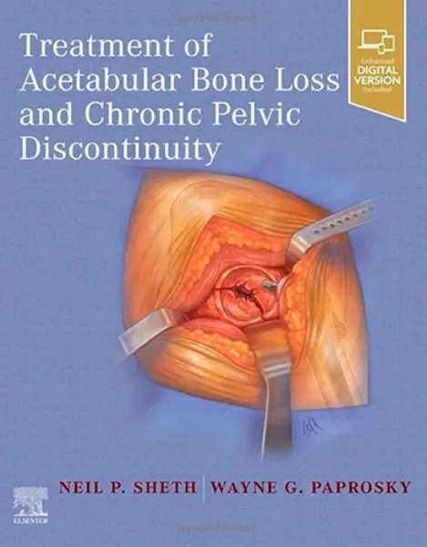 Imagem de Treatment of Acetabular Bone Loss and Chronic Pelvic Discontinuity